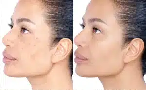 How to Get Rid of Hyperpigmentation in real